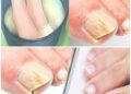 Nagelpilz mit diesen Hausmitteln beseitigen